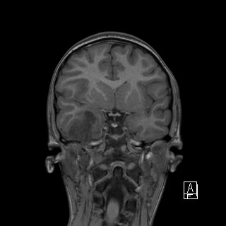 Base of skull rhabdomyosarcoma (Radiopaedia 32196-33142 Coronal T1 19).jpg