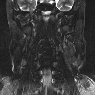 File:Base of tongue squamous cell carcinoma (Radiopaedia 31174-31884 Coronal T2 fat sat 5).jpg