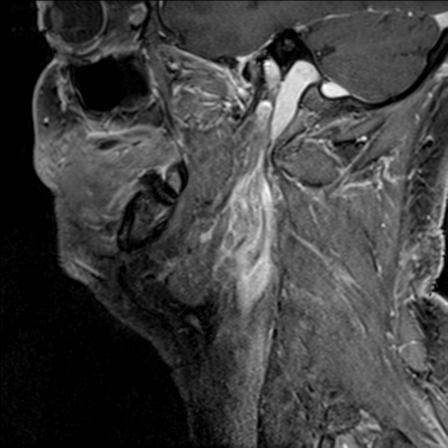 Base of tongue squamous cell carcinoma (Radiopaedia 31174-31884 F 130).jpg