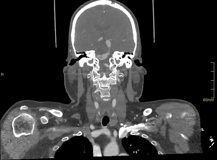 File:Basilar artery aneurysm (Radiopaedia 56261-62932 B 27).jpg