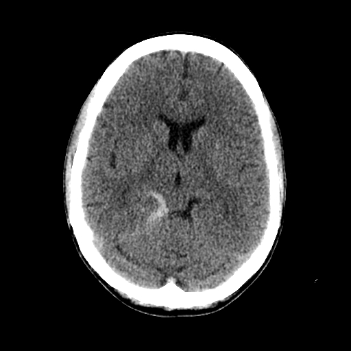 File:Basilar artery perforator aneurysm (Radiopaedia 82455-96597 Axial non-contrast 18).jpg