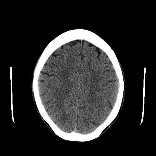 File:Basilar artery perforator aneurysm (Radiopaedia 82455-96597 Axial non-contrast 25).jpg
