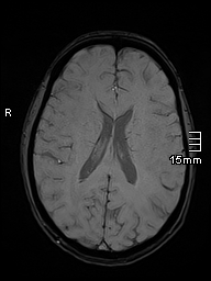 Basilar artery perforator aneurysm (Radiopaedia 82455-99523 Axial SWI 40).jpg