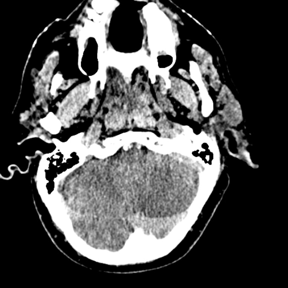 Basilar artery thrombosis (Radiopaedia 53351-59333 Axial non-contrast 30).jpg