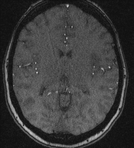 Basilar tip aneurysm (Radiopaedia 26504-26632 MRA 135).jpg