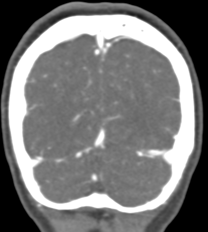 Basilar tip aneurysm with coiling (Radiopaedia 53912-60086 B 135).jpg