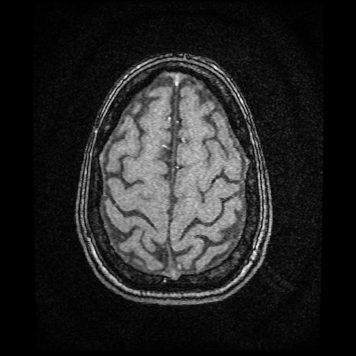 Basilar top and left middle cerebral artery aneurysm (Radiopaedia 61965-70031 Axial MRA 147).jpg