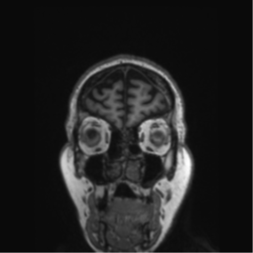 Behavioral variant frontotemporal dementia and late onset schizophrenia (Radiopaedia 52197-58083 Coronal T1 79).png