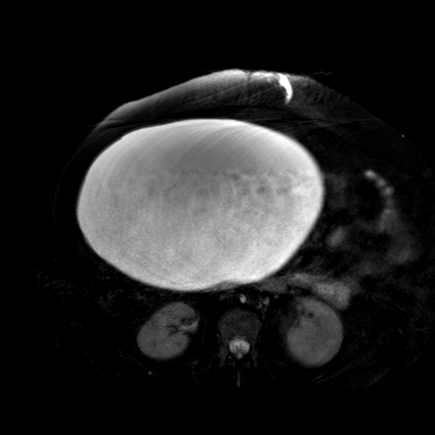 File:Benign seromucinous cystadenoma of the ovary (Radiopaedia 71065-81300 T2 SPAIR 29).jpg