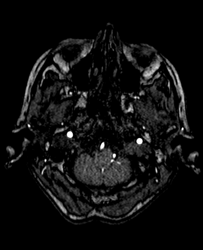 File:Berry aneurysm of the terminal internal carotid artery (Radiopaedia 88286-104918 Axial TOF 51).jpg