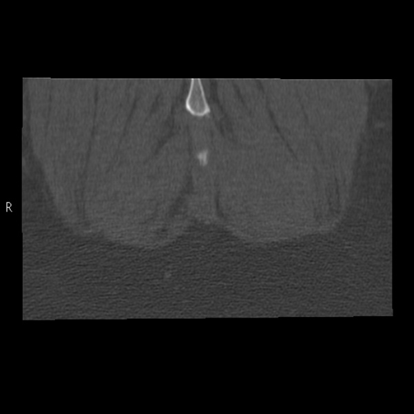 Bertolotti syndrome (Radiopaedia 24864-25128 Coronal bone window 56).jpg