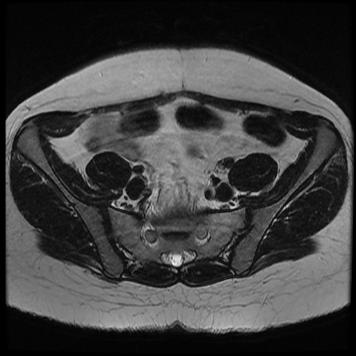 File:Bicornuate uterus (Radiopaedia 51676-57472 Axial T2 27).jpg