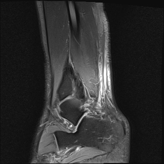 File:Bilateral Achilles tendon complete tear (Radiopaedia 81344-95051 Sagittal T2 fat sat 27).jpg
