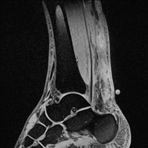 Bilateral Achilles tendon complete tear (Radiopaedia 81344-95051 Sagittal WE - Right 59).jpg