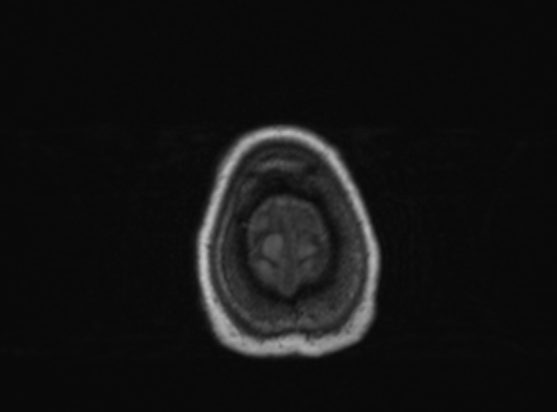 File:Bilateral PCA territory infarction - different ages (Radiopaedia 46200-51784 Axial T1 115).jpg
