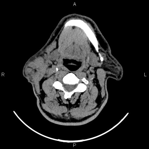 File:Bilateral Warthin tumors (Radiopaedia 84034-99263 Axial non-contrast 32).jpg