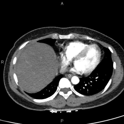 File:Bilateral adrenal gland hyperenhancement in pancreatitis (Radiopaedia 86642-102753 B 8).jpg