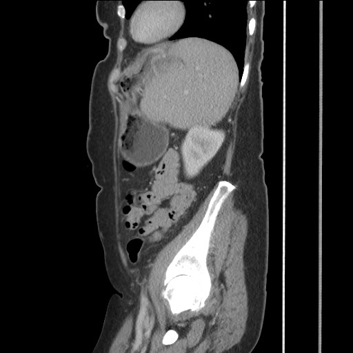 Bilateral adrenal granulocytic sarcomas (chloromas) (Radiopaedia 78375-91007 C 105).jpg