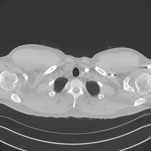 Bilateral atelectasis (Radiopaedia 48666-53675 Axial lung window 2).jpg