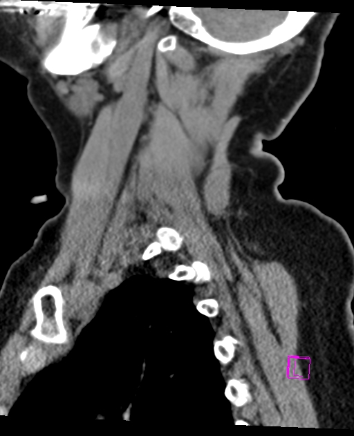 Bilateral atlanto-occipital assimilation (Radiopaedia 28350-28603 D 63).jpg