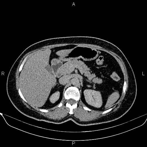 Bilateral benign adrenal adenomas (Radiopaedia 86912-103124 Axial C+ delayed 38).jpg