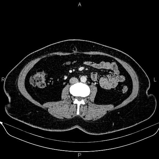 Bilateral benign adrenal adenomas (Radiopaedia 86912-103124 B 60).jpg