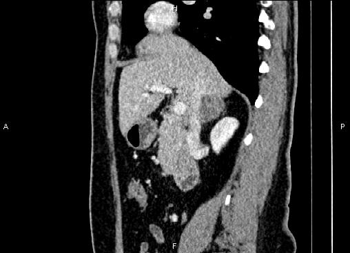 Bilateral benign adrenal adenomas (Radiopaedia 86912-103124 E 39).jpg