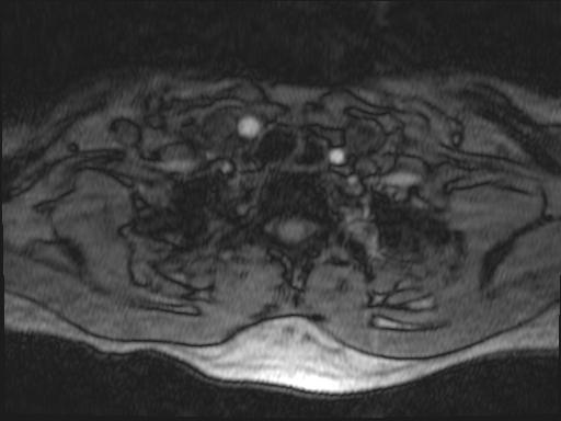Bilateral carotid body tumors and right glomus jugulare tumor (Radiopaedia 20024-20060 Axial MRA 186).jpg