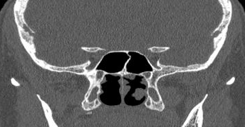 File:Bilateral ectopic infraorbital nerves (Radiopaedia 49006-54084 Coronal 1).png