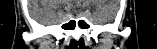 File:Bilateral enlargement of lacrimal glands - sarcoidosis (Radiopaedia 62627-70921 Coronal non-contrast 26).jpg
