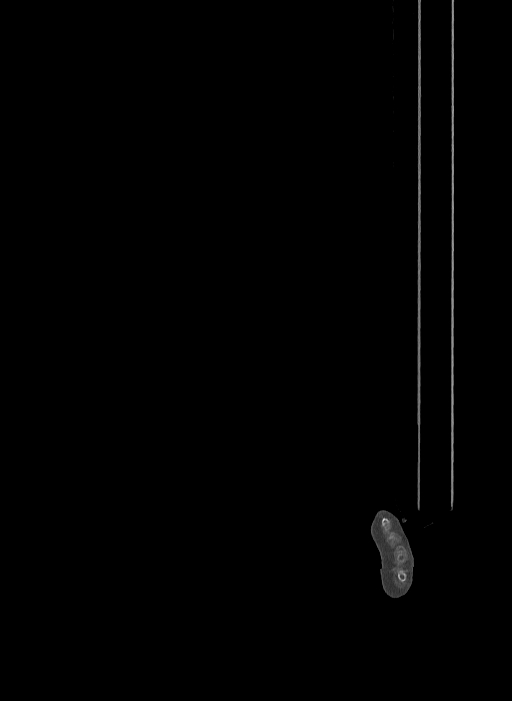 Bilateral fibular hemimelia type II (Radiopaedia 69581-79491 Sagittal bone window 5).jpg