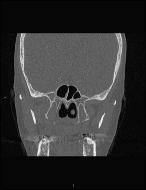 Bilateral frontal mucoceles (Radiopaedia 82352-96454 Coronal 223).jpg
