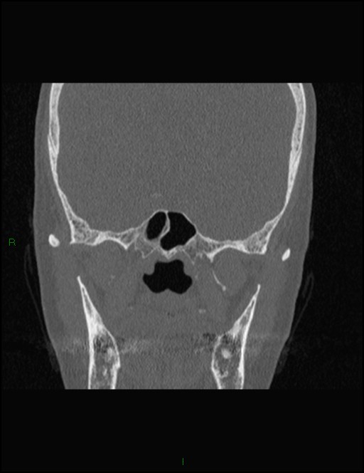 Bilateral frontal mucoceles (Radiopaedia 82352-96454 Coronal 234).jpg