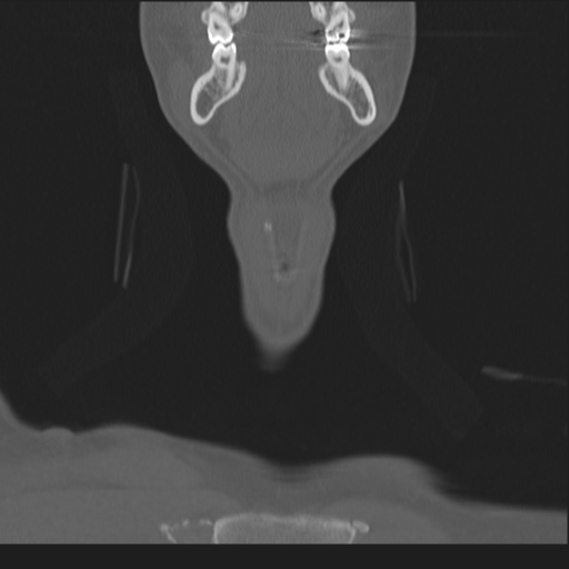 Bilateral locked facets (Radiopaedia 33850-35016 Coronal bone window 8).png