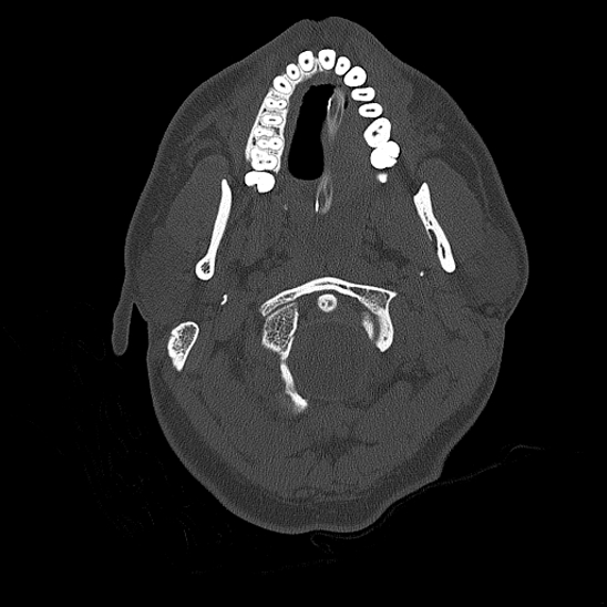 File:Bilateral occipital condyle fracture (type 2) (Radiopaedia 87675-104089 Axial bone thins 4).jpg