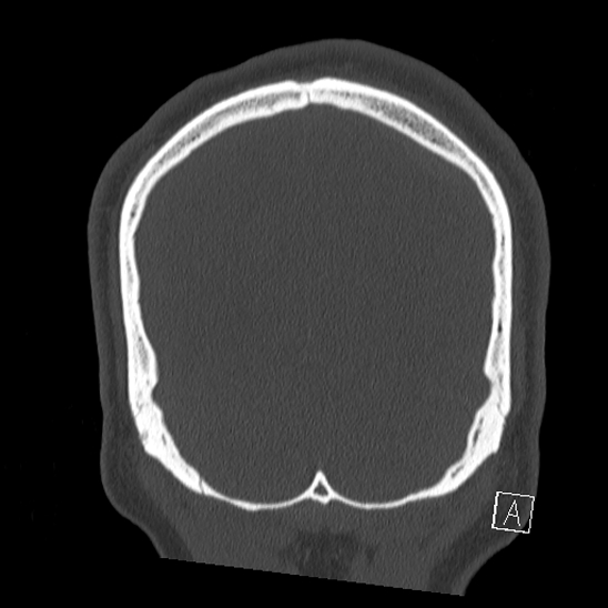 Bilateral occipital condyle fracture (type 2) (Radiopaedia 87675-104089 Coronal bone window 126).jpg