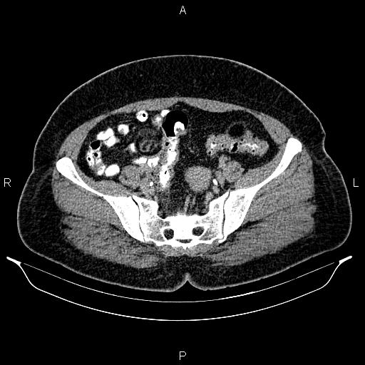 Bilateral ovarian dermoid cysts (Radiopaedia 85785-101603 Axial C+ delayed 63).jpg