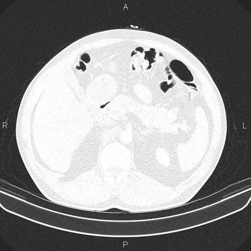 File:Bilateral pulmonary AVM (Radiopaedia 83134-97505 Axial lung window 79).jpg