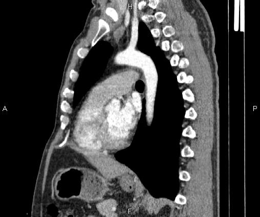Bilateral pulmonary AVM (Radiopaedia 83134-97505 D 68).jpg