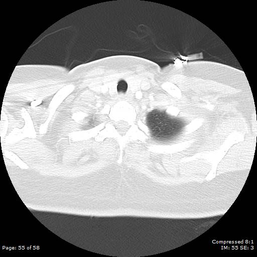 Bilateral pulmonary emboli with Hampton hump sign (Radiopaedia 54070-60246 Axial lung window 55).jpg
