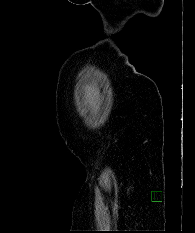 Bilateral sporadic synchronous clear cell renal cell carcinoma (Radiopaedia 85035-100575 E 118).jpg