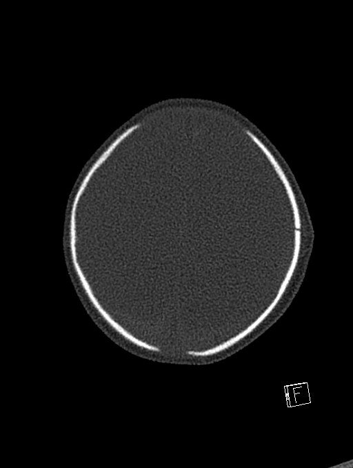Bilateral subdural hemorrhage and parietal skull fracture (Radiopaedia 26058-26192 Axial bone window 21).png
