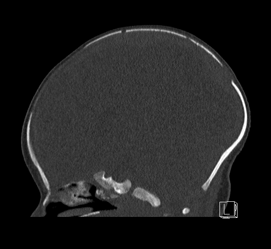 Bilateral subdural hemorrhage and parietal skull fracture (Radiopaedia 26058-26192 Sagittal bone window 53).png