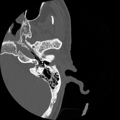 Bilateral temporal bone fractures (Radiopaedia 29482-29970 D 75).jpg