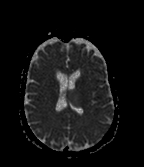 File:Bilateral thalamic glioma (Radiopaedia 65852-75009 Axial ADC 14).jpg