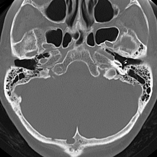 File:Bilateral tympanoplasty (Radiopaedia 16947-16664 Axial bone window 17).jpg