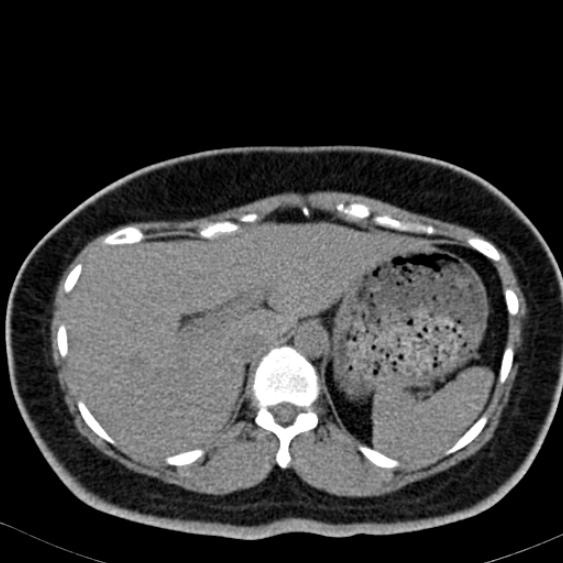 Bilateral ureteric stents (Radiopaedia 48795-53825 Axial non-contrast 8).jpg