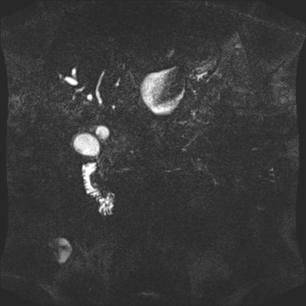 Biliary pancreatitis (Radiopaedia 72289-82824 Coronal 3D T2 60).jpg
