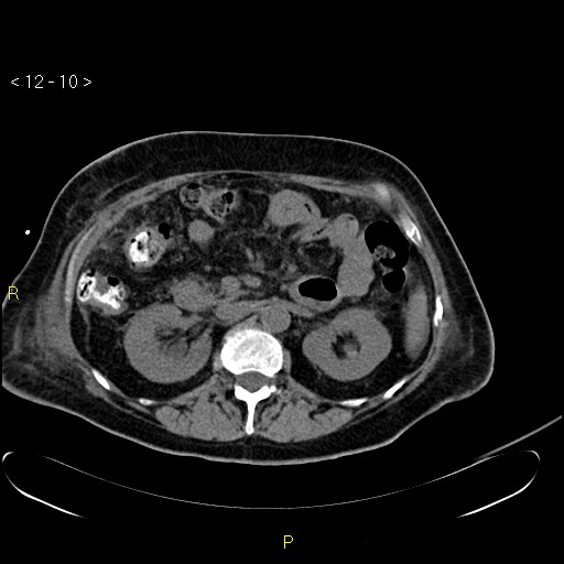 File:Biloma with drainage into the colon (Radiopaedia 20032-20068 B 19).jpg