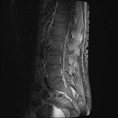 File:Bing-Neel syndrome (Radiopaedia 71453-81799 A 13).jpg
